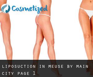 Liposuction in Meuse by main city - page 1