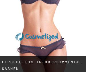 Liposuction in Obersimmental-Saanen