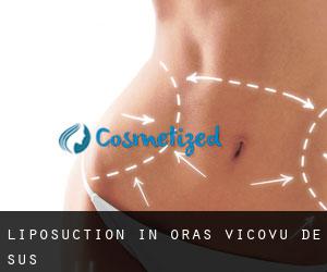 Liposuction in Oraş Vicovu De Sus