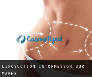 Liposuction in Ormesson-sur-Marne