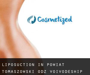 Liposuction in Powiat tomaszowski (Łódź Voivodeship)
