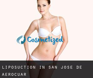 Liposuction in San José de Aerocuar