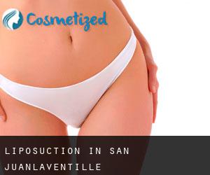Liposuction in San Juan/Laventille