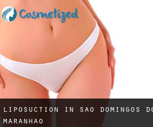 Liposuction in São Domingos do Maranhão