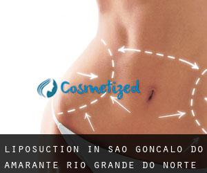 Liposuction in São Gonçalo do Amarante (Rio Grande do Norte)