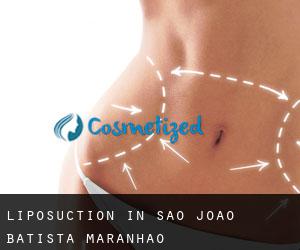Liposuction in São João Batista (Maranhão)
