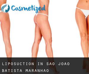 Liposuction in São João Batista (Maranhão)