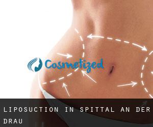 Liposuction in Spittal an der Drau