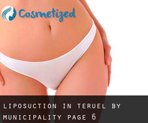 Liposuction in Teruel by municipality - page 6