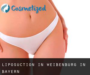 Liposuction in Weißenburg in Bayern