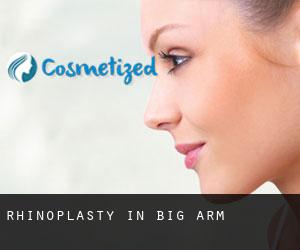 Rhinoplasty in Big Arm