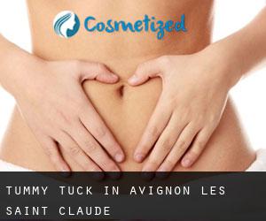 Tummy Tuck in Avignon-lès-Saint-Claude
