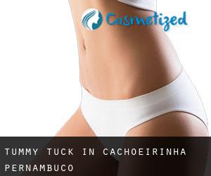 Tummy Tuck in Cachoeirinha (Pernambuco)