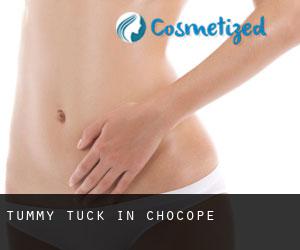 Tummy Tuck in Chocope