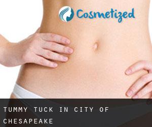 Tummy Tuck in City of Chesapeake