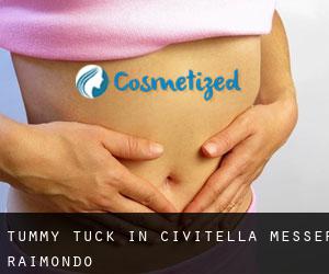 Tummy Tuck in Civitella Messer Raimondo