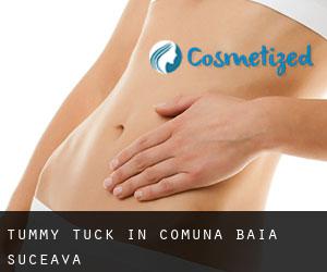 Tummy Tuck in Comuna Baia (Suceava)