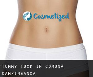 Tummy Tuck in Comuna Câmpineanca