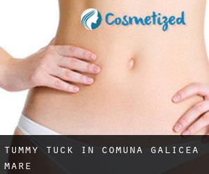 Tummy Tuck in Comuna Galicea Mare