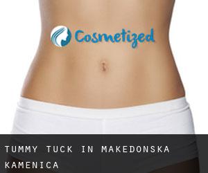 Tummy Tuck in Makedonska Kamenica