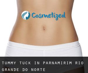 Tummy Tuck in Parnamirim (Rio Grande do Norte)